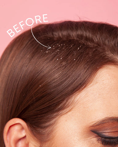 Siero cuoio capelluto anti Forfora e prevenzione Pidocchi